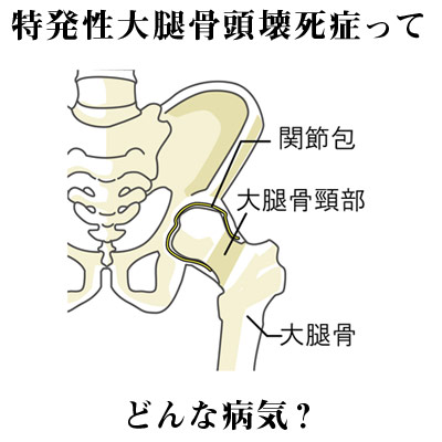 特発性大腿骨頭壊死症ってどんな病気? 股関節の名称